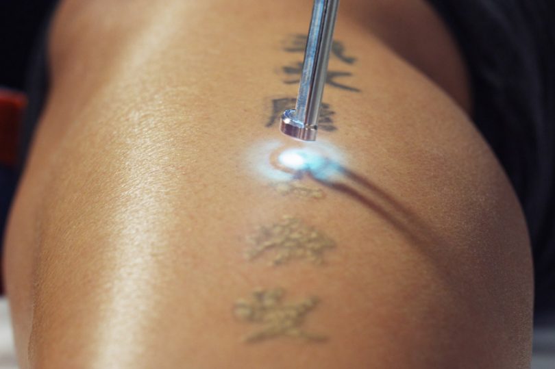 Melhor forma de remover uma tatuagem