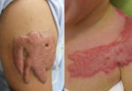 Remoção de Tatuagem - Cicatriz de Queloide em tatuagem