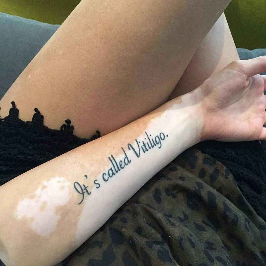 Tatuagem e vitiligo
