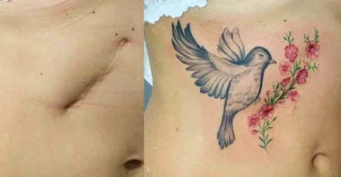 Tatuagem para cobrir cicatriz